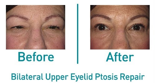 Bilateral upper eyelid ptosis — before and after from the practice gallery