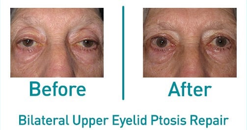Bilateral upper ptosis — before and after from the practice gallery