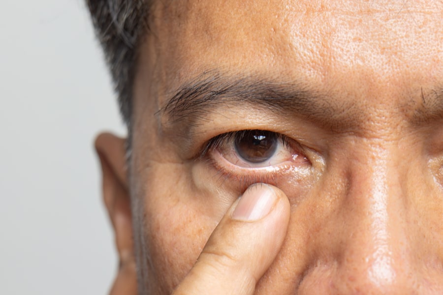 Blepharospasm