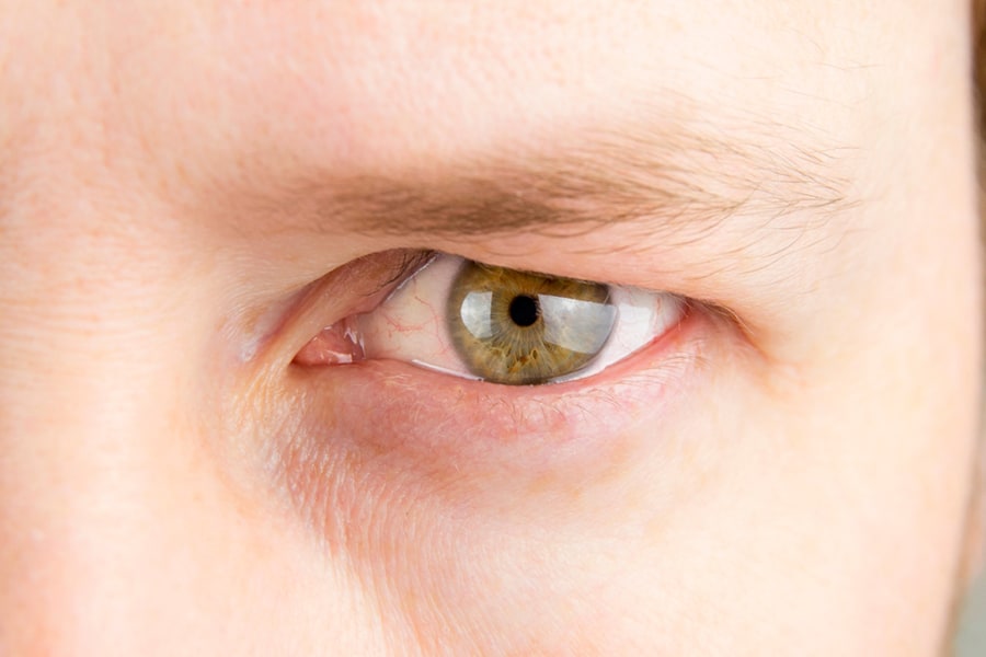 Eyelid Surgery