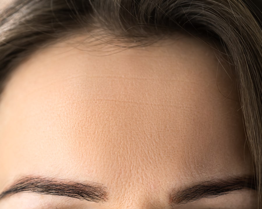 Brow lift