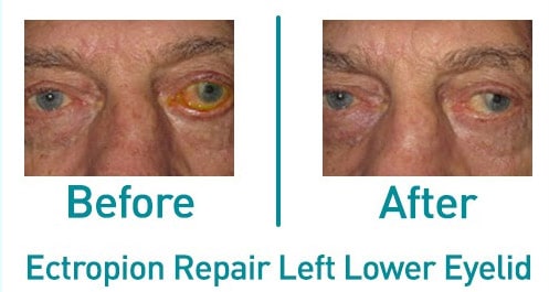 Left lower ectropion repair — before and after from the practice gallery