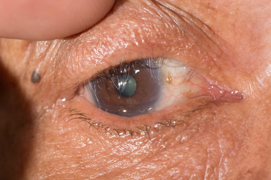 Ectropion Repair