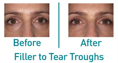 Tear-trough filler — before and after from the practice gallery