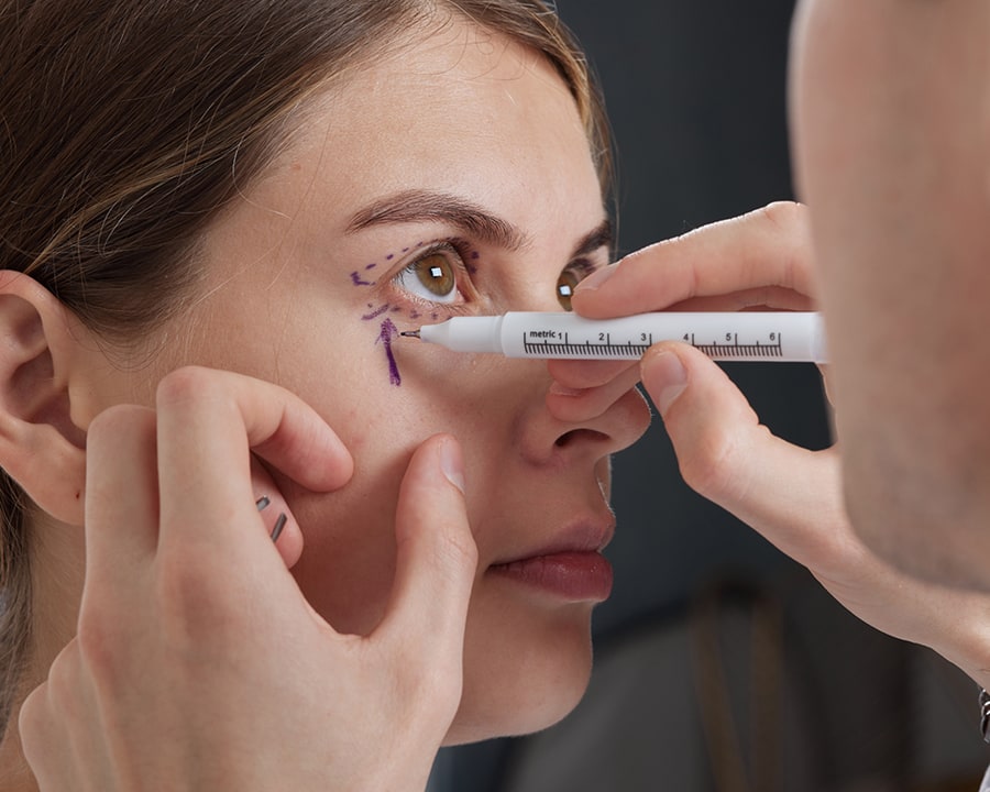 Blepharoplasty