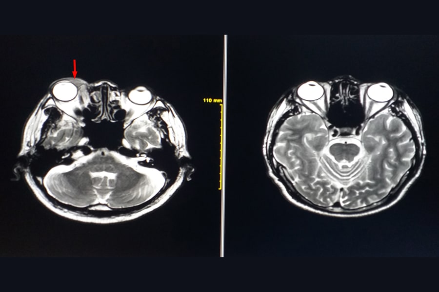Orbital Tumors