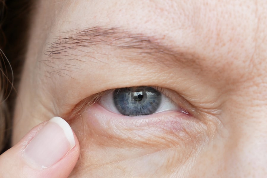 Ptosis