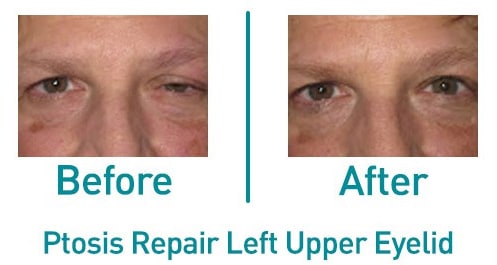 Left upper ptosis repair — before and after from the practice gallery