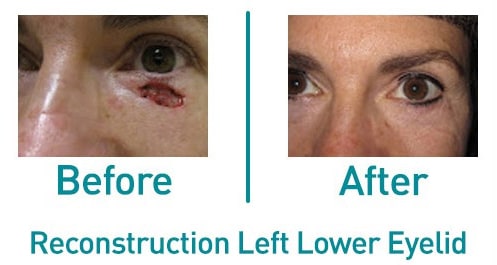 Left lower eyelid reconstruction — before and after from the practice gallery