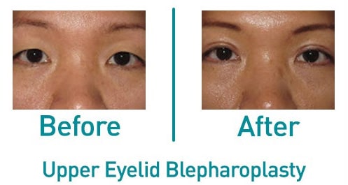 Before and after upper eyelid blepharoplasty, from the practice gallery